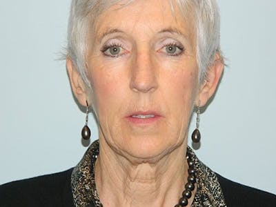 Mini-Facelift Before & After Gallery - Patient 133066429 - Image 1