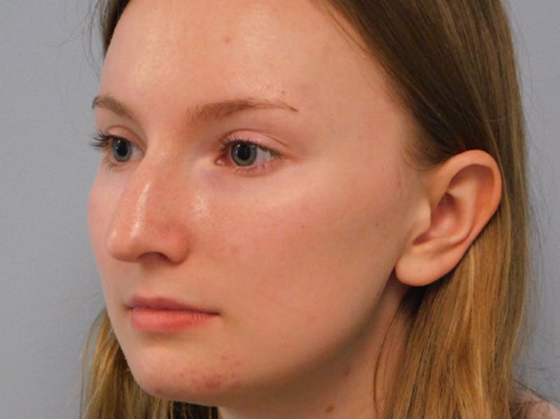Rhinoplasty Before & After Gallery - Patient 133066432 - Image 1