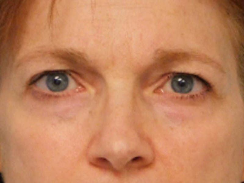 Blepharoplasty (Eyelid Lift) Before & After Gallery - Patient 133066431 - Image 1