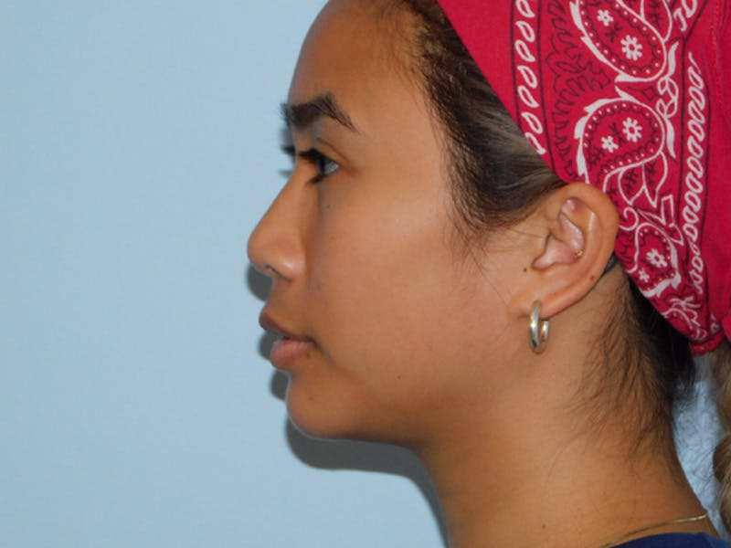 Chin Augmentation Before & After Gallery - Patient 133066427 - Image 2