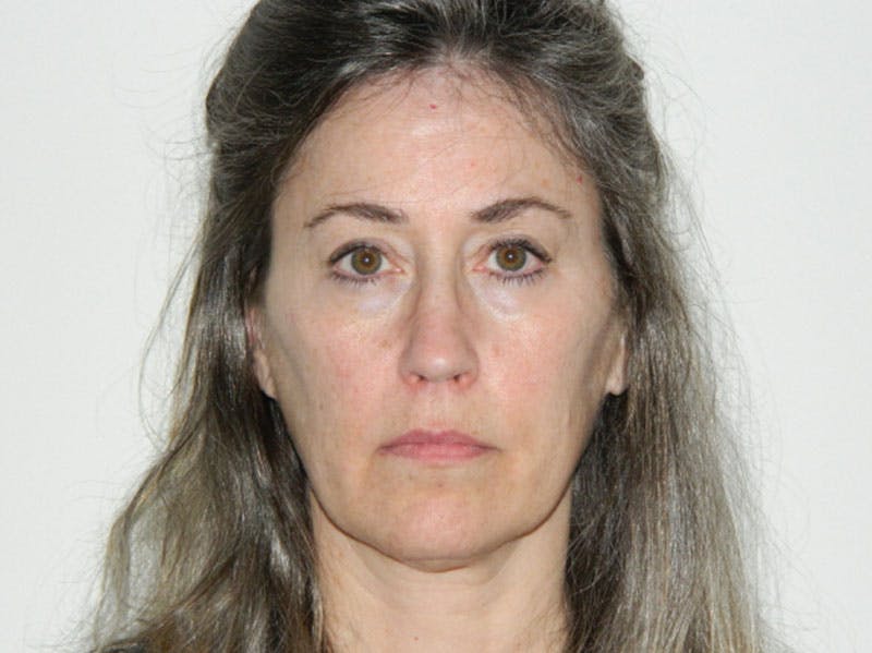 Neck (Submental) Liposuction Before & After Gallery - Patient 133066425 - Image 5