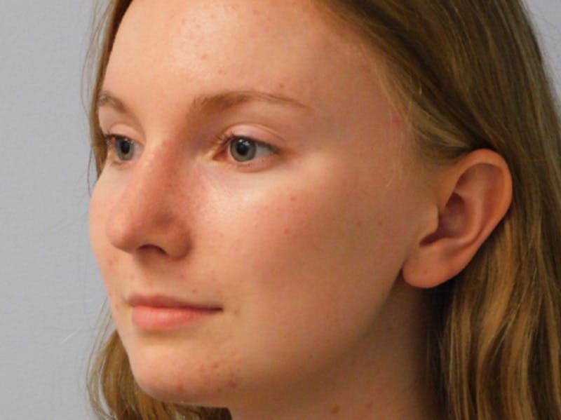 Rhinoplasty Before & After Gallery - Patient 133066432 - Image 2