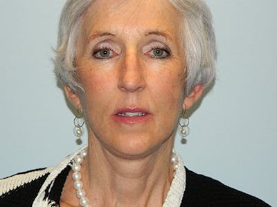 Mini-Facelift Before & After Gallery - Patient 133066429 - Image 2