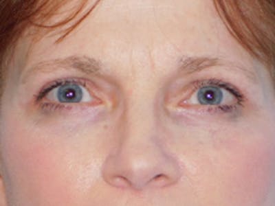 Blepharoplasty (Eyelid Lift) Before & After Gallery - Patient 133066431 - Image 2