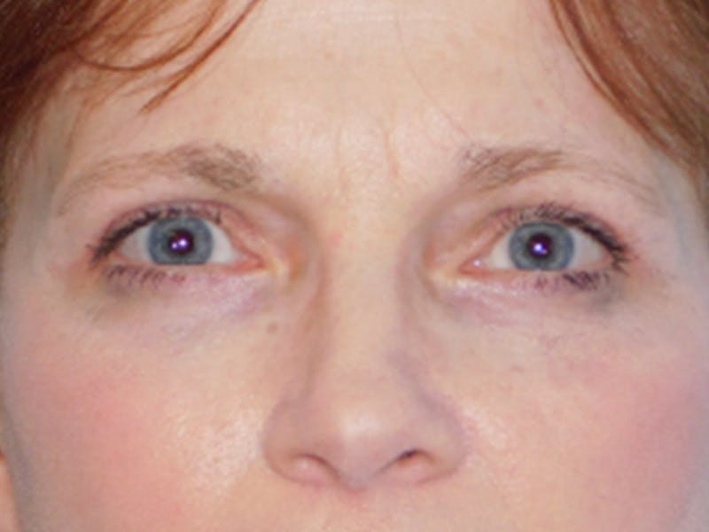 Blepharoplasty (Eyelid Lift) Before & After Gallery - Patient 133066431 - Image 2