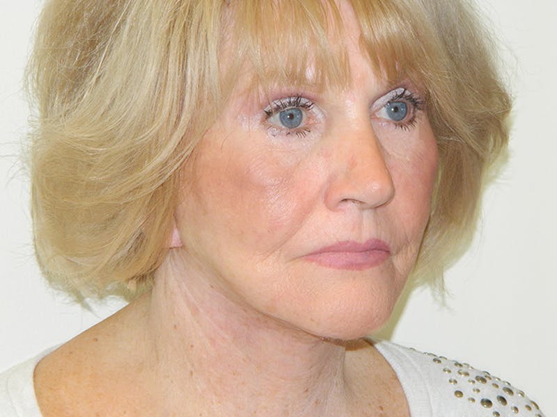Facelift Before & After Gallery - Patient 133066430 - Image 2