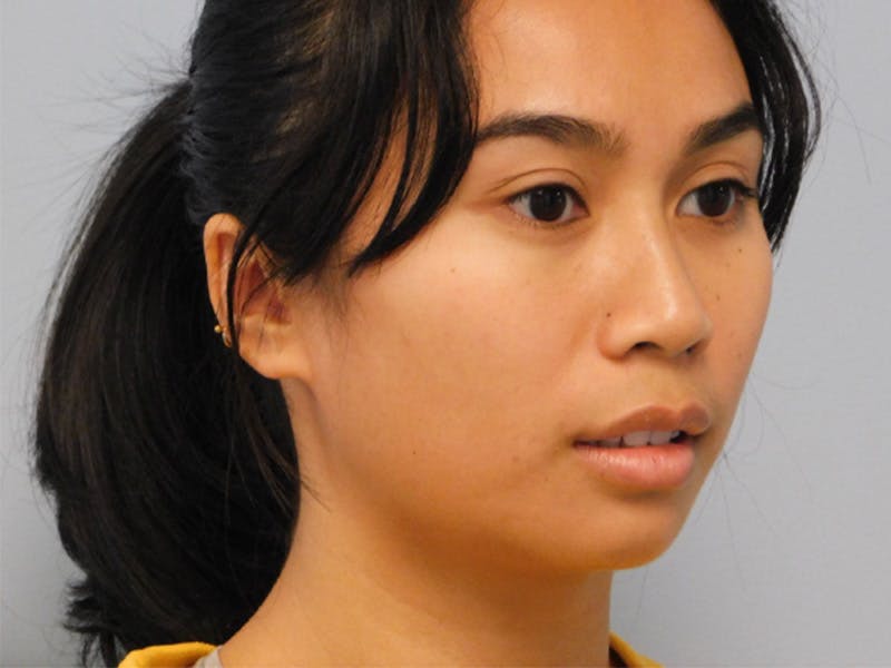 Chin Augmentation Before & After Gallery - Patient 133066427 - Image 3