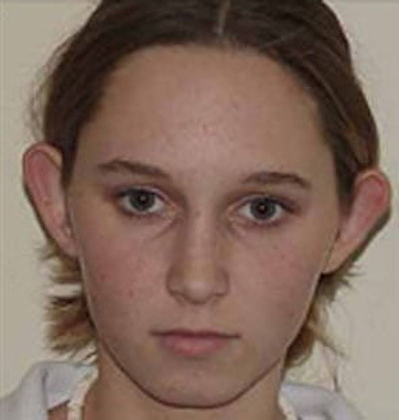 Otoplasty Before & After Gallery - Patient 133066428 - Image 1