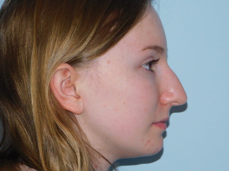 Rhinoplasty Before & After Gallery - Patient 133066432 - Image 3