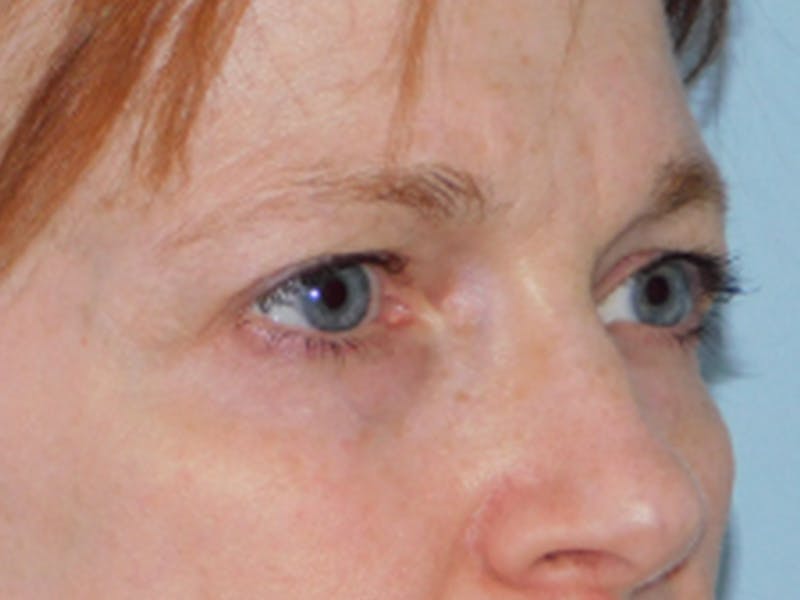 Blepharoplasty (Eyelid Lift) Before & After Gallery - Patient 133066431 - Image 3