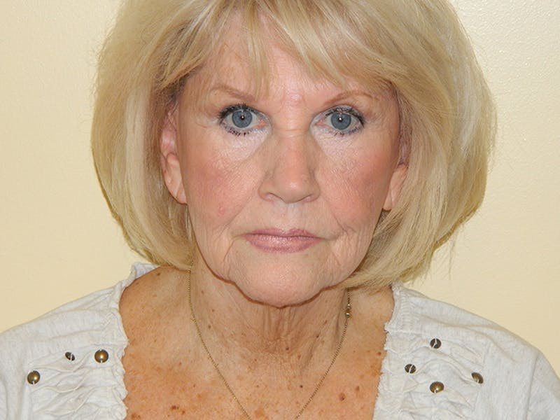 Facelift Before & After Gallery - Patient 133066430 - Image 3