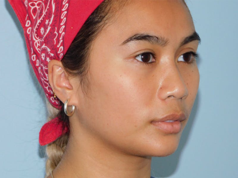 Chin Augmentation Before & After Gallery - Patient 133066427 - Image 4