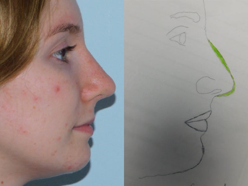 Rhinoplasty Before & After Gallery - Patient 133066432 - Image 4