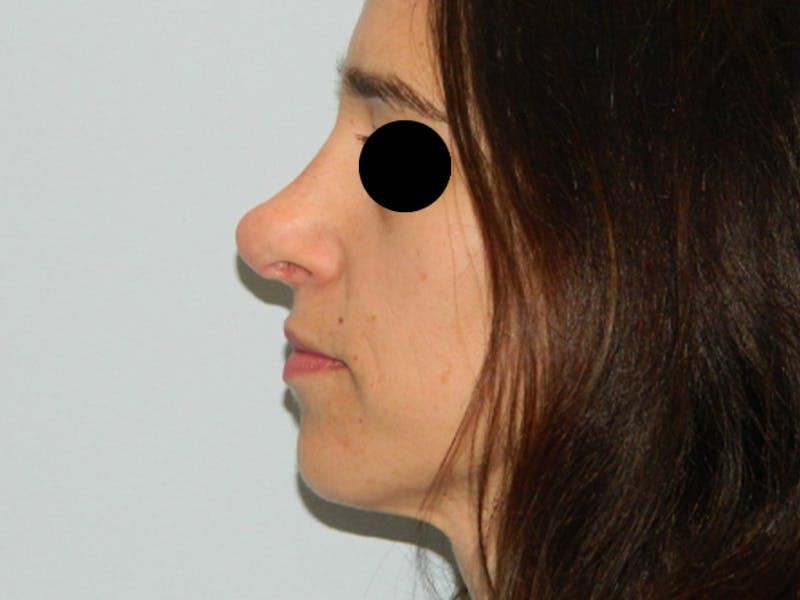 Revision Rhinoplasty Before & After Gallery - Patient 133066439 - Image 1