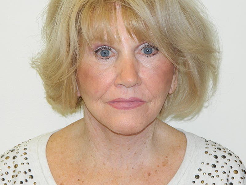 Facelift Before & After Gallery - Patient 133066430 - Image 4