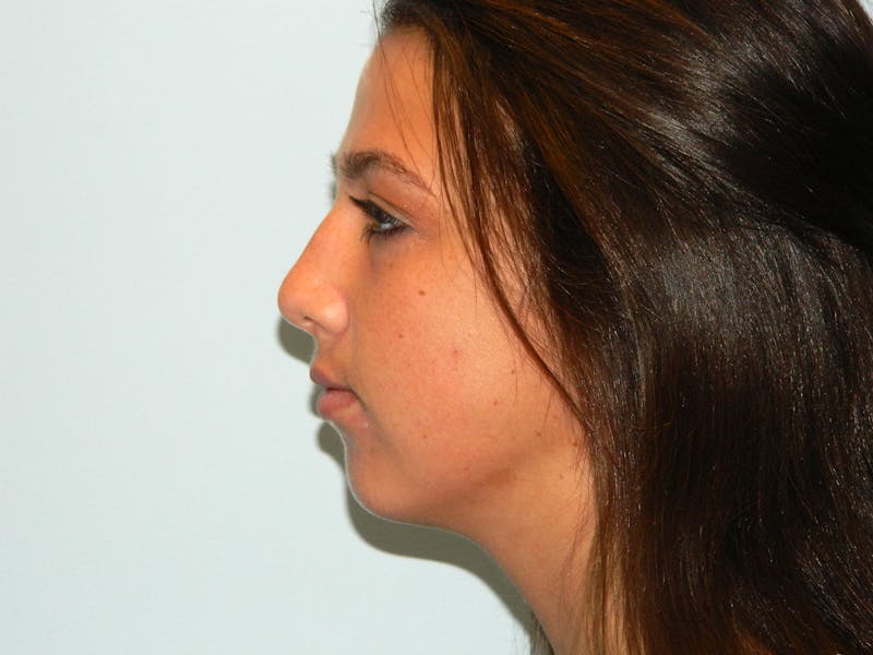 Chin Augmentation Before & After Gallery - Patient 133066448 - Image 1
