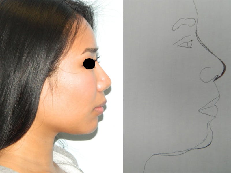 Neck (Submental) Liposuction Before & After Gallery - Patient 133066437 - Image 2