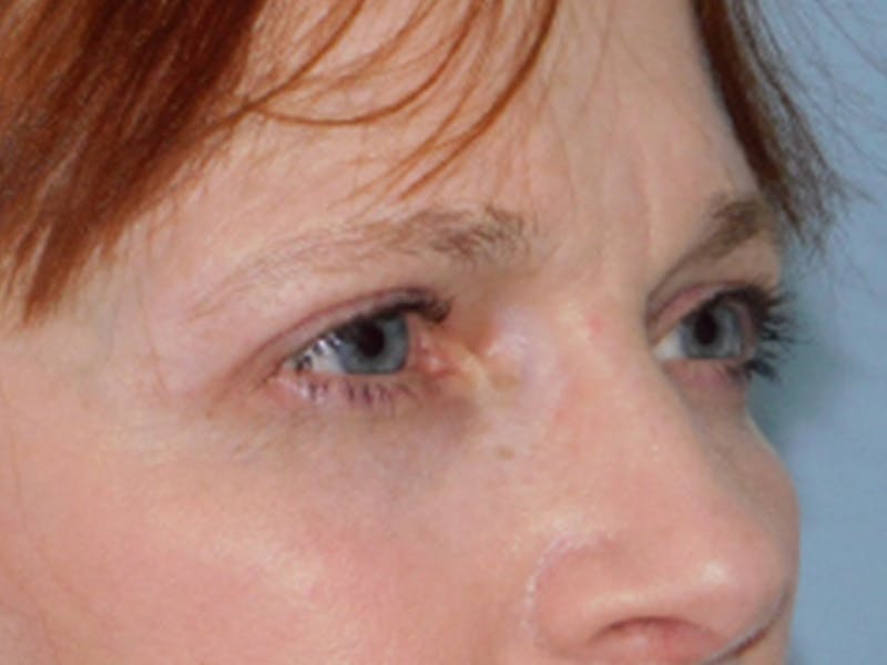 Blepharoplasty (Eyelid Lift) Before & After Gallery - Patient 133066431 - Image 4