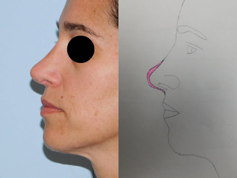 Revision Rhinoplasty Before & After Gallery - Patient 133066439 - Image 2