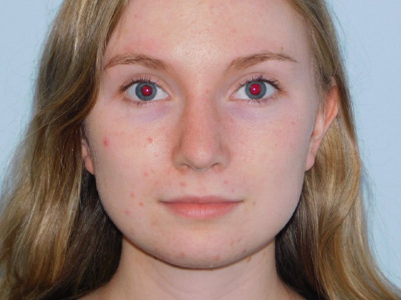 Rhinoplasty Before & After Gallery - Patient 133066432 - Image 6
