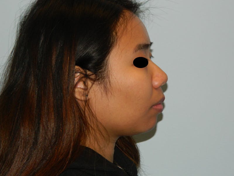 Neck (Submental) Liposuction Before & After Gallery - Patient 133066437 - Image 3