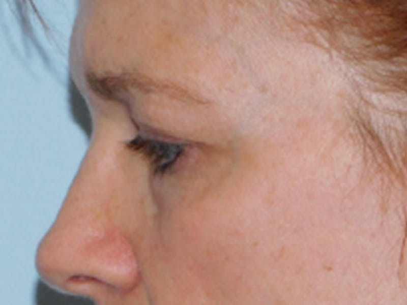Blepharoplasty (Eyelid Lift) Before & After Gallery - Patient 133066431 - Image 5