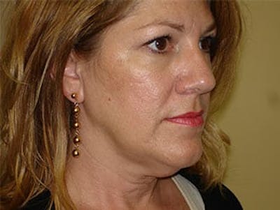 Facelift Before & After Gallery - Patient 133066433 - Image 1