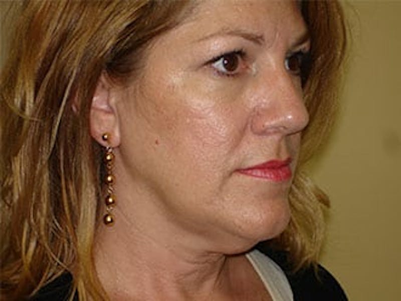 Facelift Before & After Gallery - Patient 133066433 - Image 1