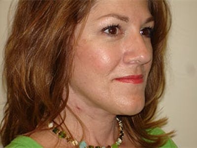Facelift Before & After Gallery - Patient 133066433 - Image 2