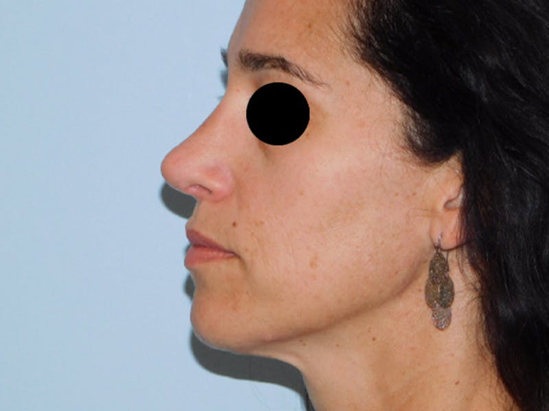 Revision Rhinoplasty Before & After Gallery - Patient 133066439 - Image 4