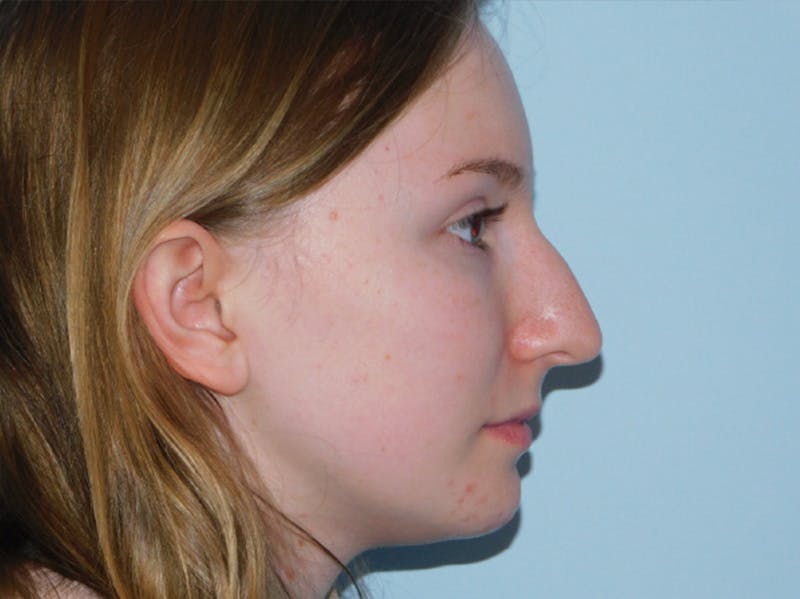 Rhinoplasty Before & After Gallery - Patient 133066432 - Image 7