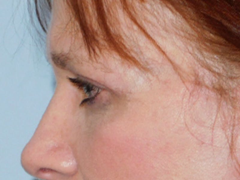 Blepharoplasty (Eyelid Lift) Before & After Gallery - Patient 133066431 - Image 6