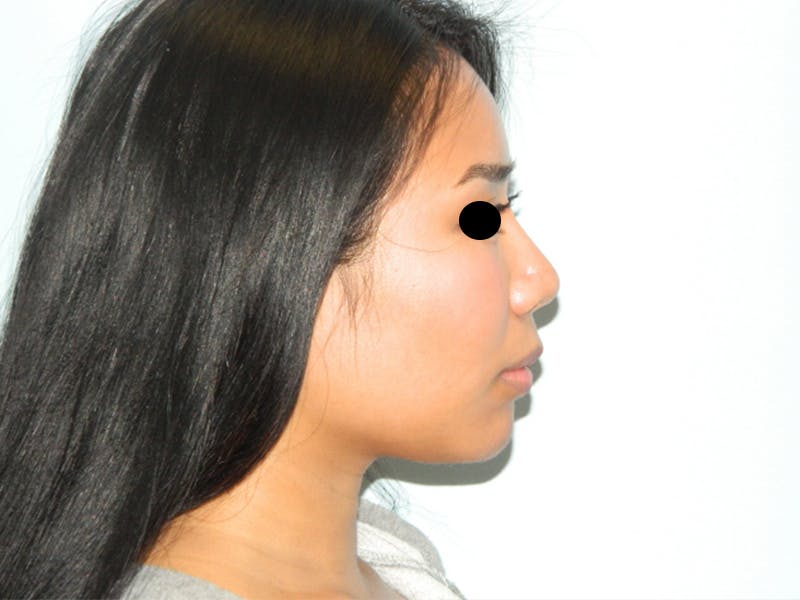 Neck (Submental) Liposuction Before & After Gallery - Patient 133066437 - Image 4