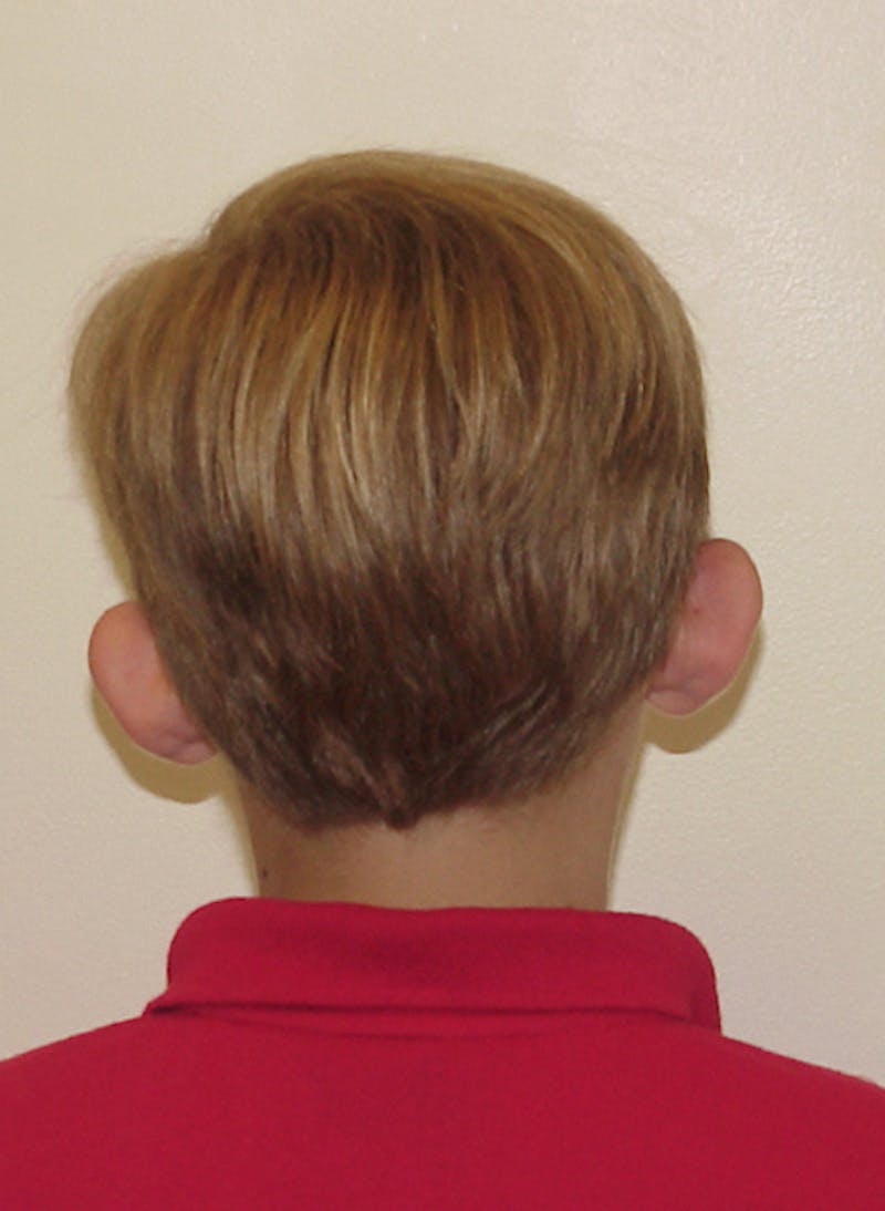 Otoplasty Before & After Gallery - Patient 133066434 - Image 3