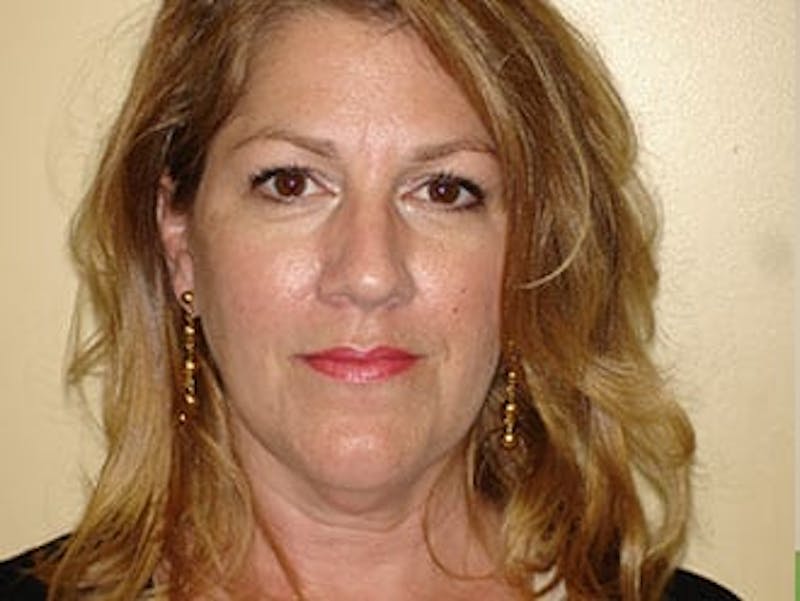 Facelift Before & After Gallery - Patient 133066433 - Image 3