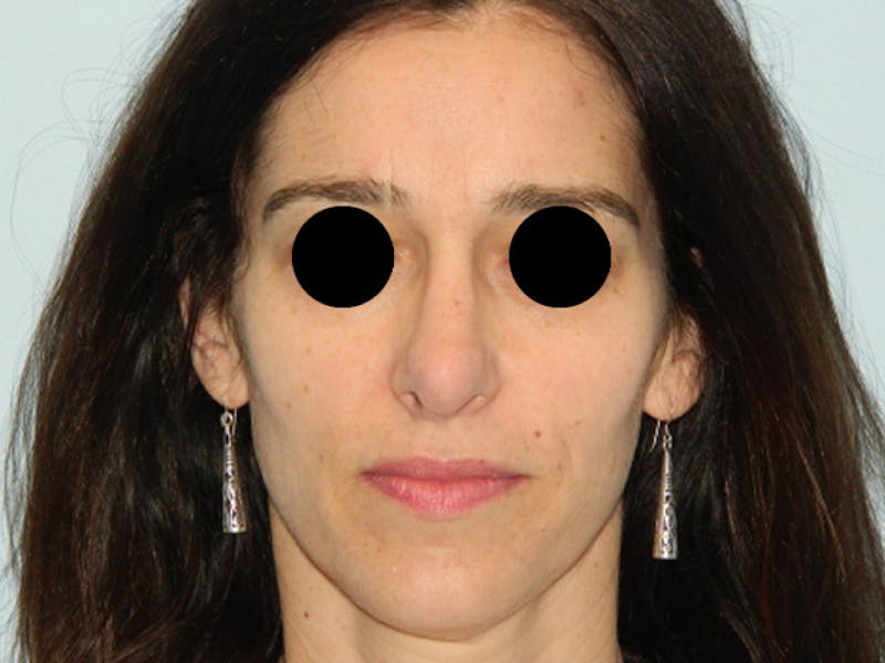 Revision Rhinoplasty Before & After Gallery - Patient 133066439 - Image 5