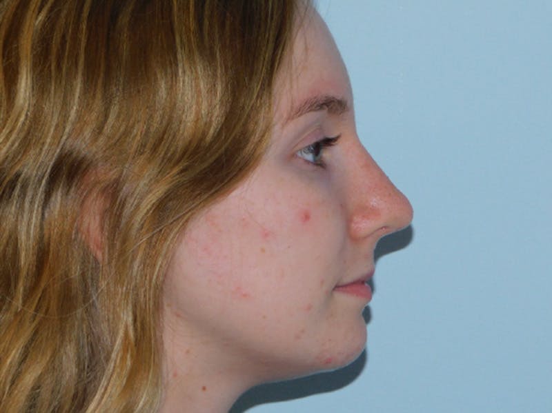 Rhinoplasty Before & After Gallery - Patient 133066432 - Image 8