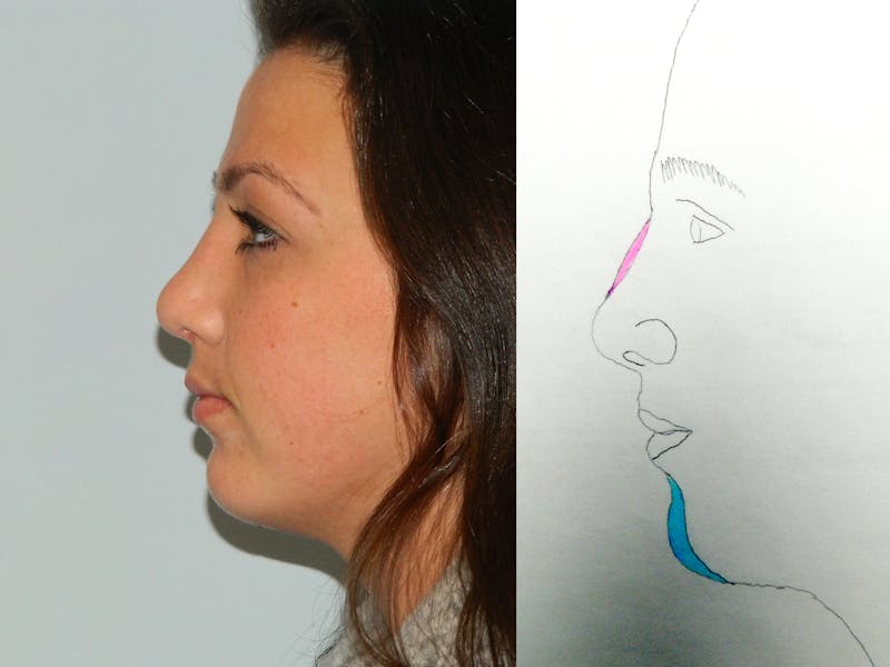 Chin Augmentation Before & After Gallery - Patient 133066448 - Image 2
