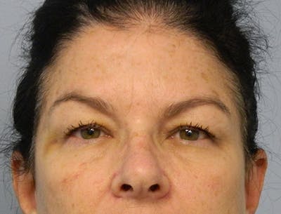 Blepharoplasty (Eyelid Lift) Before & After Gallery - Patient 133066438 - Image 1
