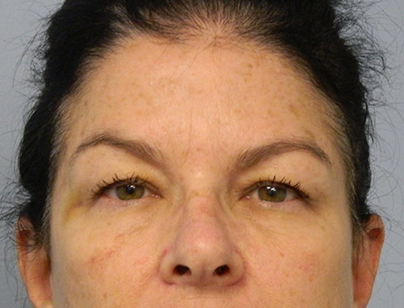 Blepharoplasty (Eyelid Lift) Before & After Gallery - Patient 133066438 - Image 1