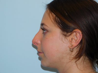 Rhinoplasty Before & After Gallery - Patient 133066450 - Image 1