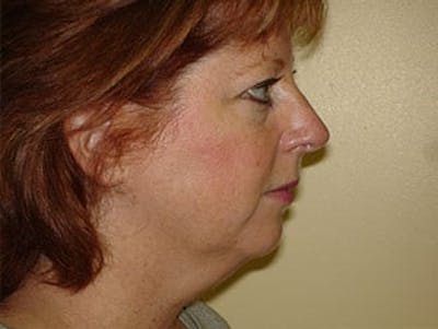 Facelift Before & After Gallery - Patient 133066442 - Image 1