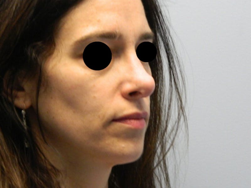 Revision Rhinoplasty Before & After Gallery - Patient 133066439 - Image 7