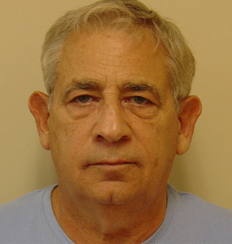 Otoplasty Before & After Gallery - Patient 133066435 - Image 1