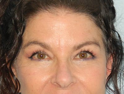 Blepharoplasty (Eyelid Lift) Before & After Gallery - Patient 133066438 - Image 2