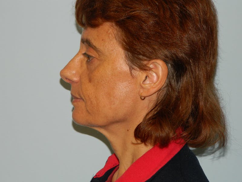 Mini-Facelift Before & After Gallery - Patient 133066440 - Image 3