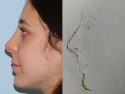 Rhinoplasty Before & After Gallery - Patient 133066450 - Image 2