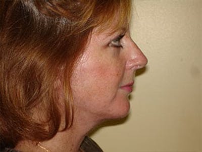 Facelift Before & After Gallery - Patient 133066442 - Image 2