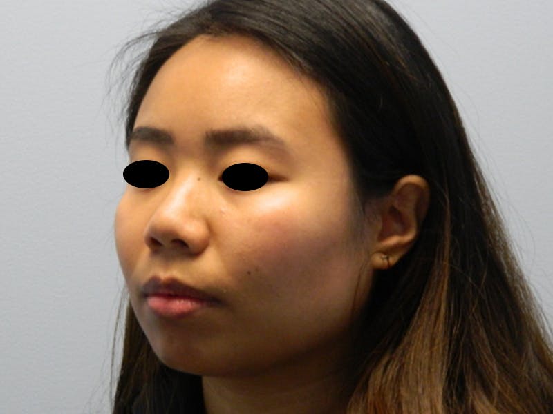 Neck (Submental) Liposuction Before & After Gallery - Patient 133066437 - Image 7