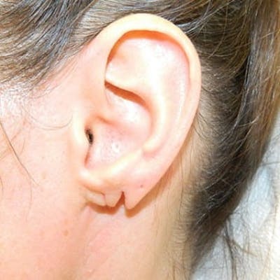 Earlobe Repair Before & After Gallery - Patient 133066436 - Image 1